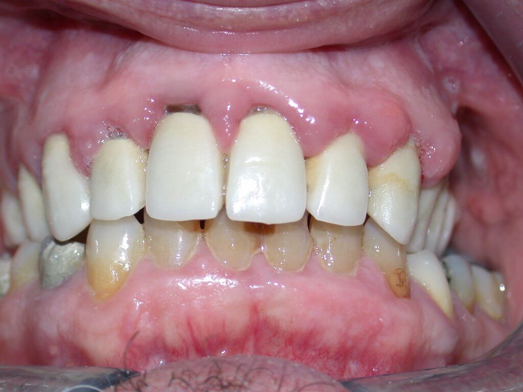 Morfologia gengivale, spunti per modellazione e colorazione Yen co