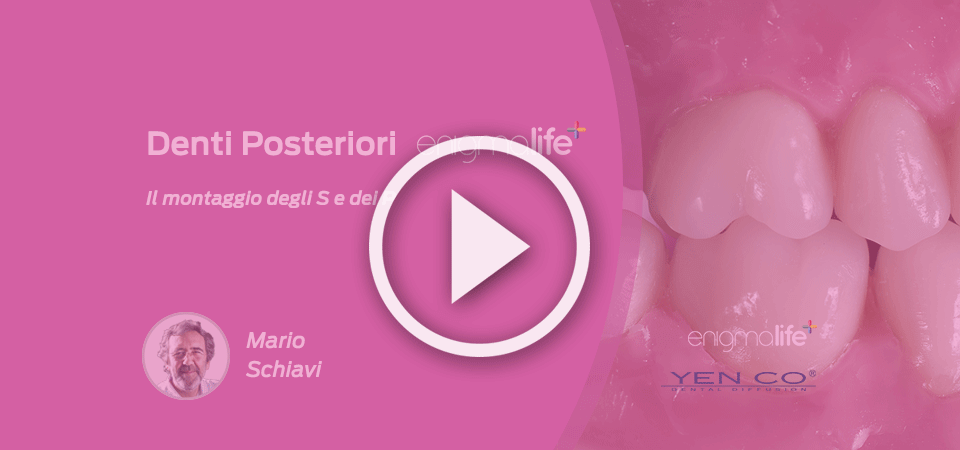VIDEO | Denti Posteriori Enigmalife+, il montaggio degli S e dei P