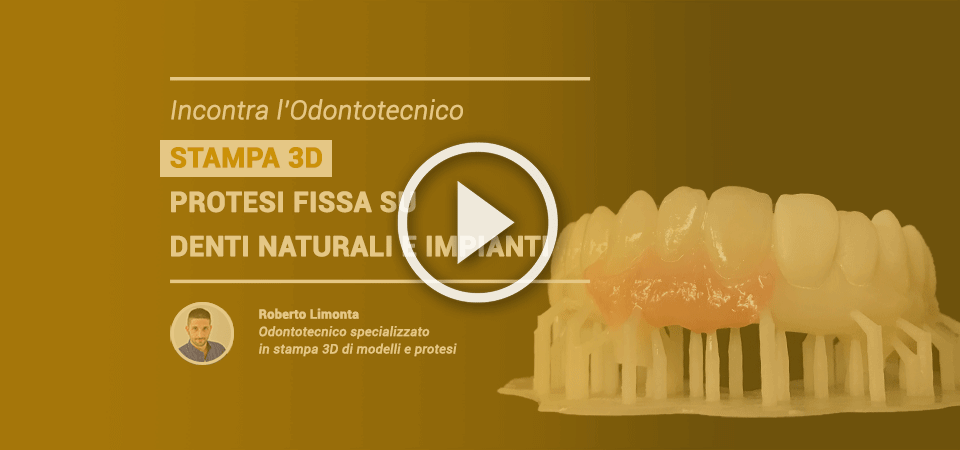 VIDEO | Incontra l’odontotecnico: Stampa 3D – Protesi fissa su denti naturali e impianti