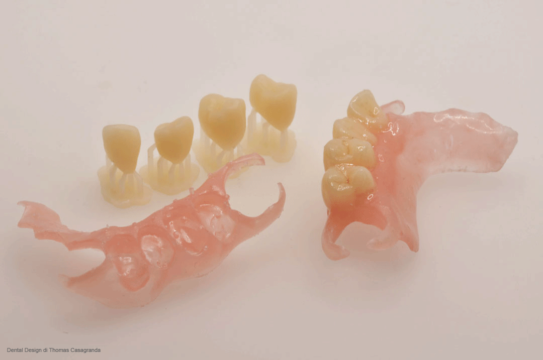 esito di stampa 3D di protesi parziale rimovibile