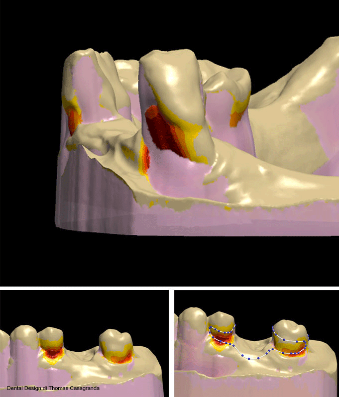 progetto 3shape Dental Manager per stampa 3D di protesi parziale flessibile