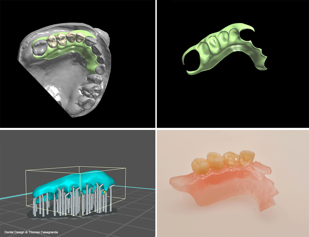 stampa 3D di protesi parziale rimovibile flessibile