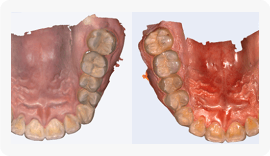 intraoral-scanner-INO200-real-color-texture-scan-1